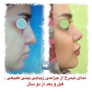 جراحی-بینی-طبیعی-1