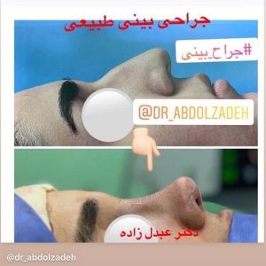 جراحی-بینی-طبیعی-10
