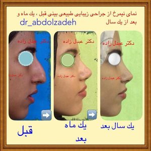 جراحی-بینی-طبیعی-4