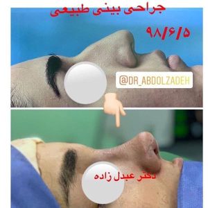 جراحی-بینی-طبیعی-7