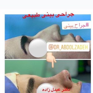 جراحی-بینی-طبیعی-8