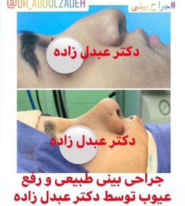 جراحی-بینی-طبیعی-9