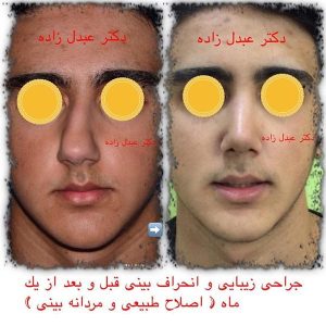 جراحی-بینی-مردانه-1