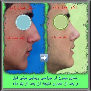 جراحی-بینی-مردانه-10