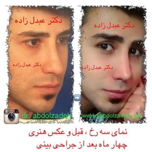 جراحی-بینی-مردانه-12