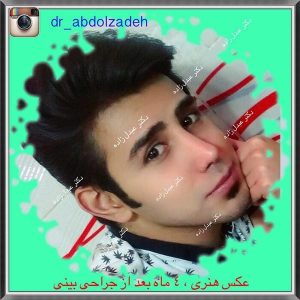 جراحی-بینی-مردانه-13