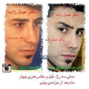 جراحی-بینی-مردانه-14