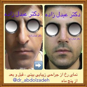 جراحی-بینی-مردانه-15