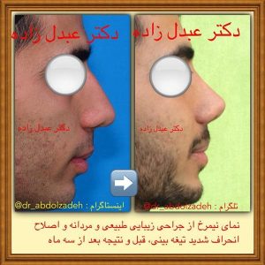 جراحی-بینی-مردانه-4