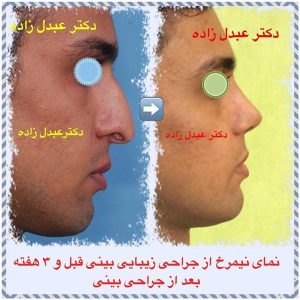 جراحی-بینی-مردانه-9
