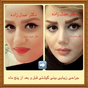 جراحی-بینی-گوشتی-2