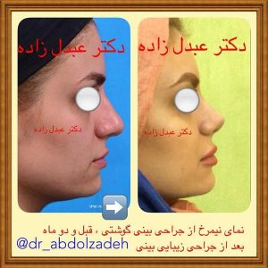 جراحی-بینی-گوشتی-6