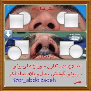 جراحی-بینی-گوشتی-7