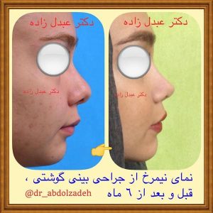 جراحی-بینی-گوشتی-8
