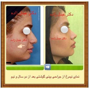 جراحی-بینی-گوشتی-9