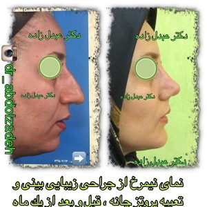 جراحی-بینی-20