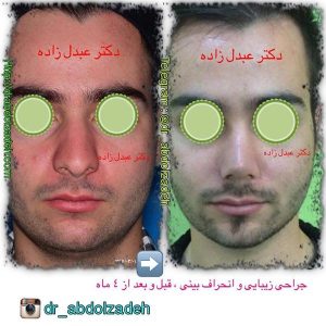 جراحی-بینی-21