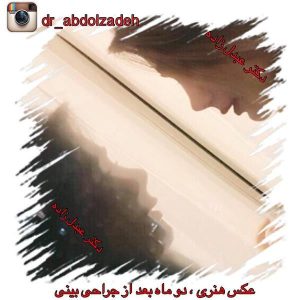 جراحی-بینی-23