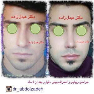 جراحی-بینی-25