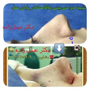 جراحی-بینی-27