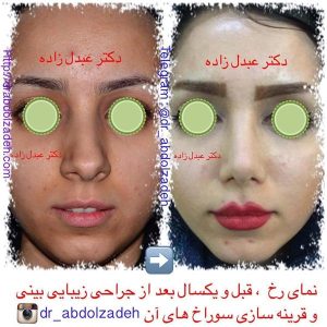 جراحی-بینی-29
