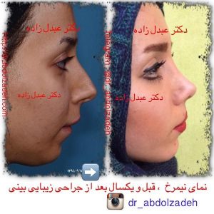 جراحی-بینی-30