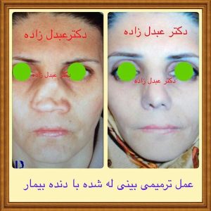 جراحی-بینی-32