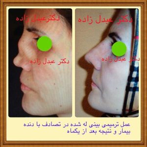 جراحی-بینی-33