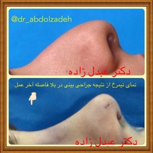 جراحی-بینی-37