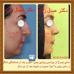 جراحی-بینی-39