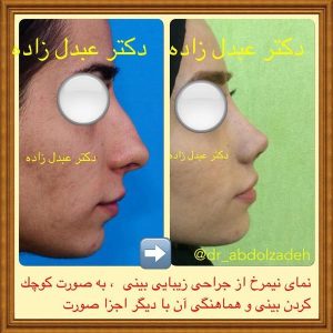 جراحی-بینی-40