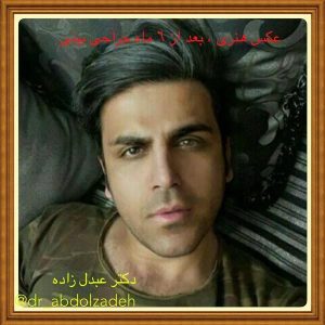 جراحی-بینی-41