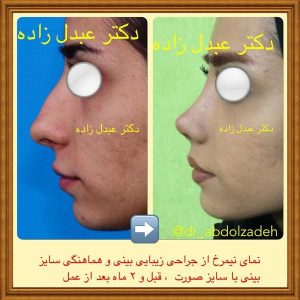 جراحی-بینی-42
