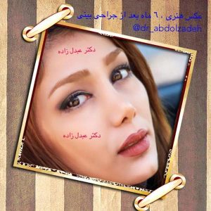 جراحی-بینی-43