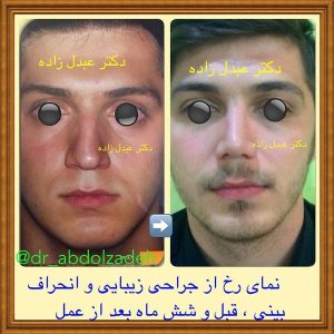 جراحی-بینی-46