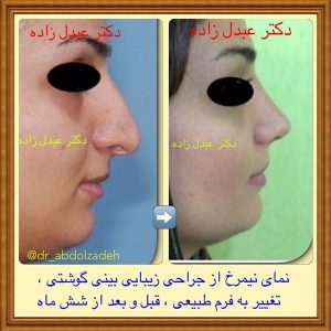 جراحی-بینی-47