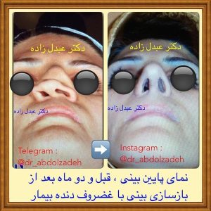 جراحی-بینی-48