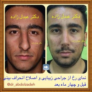 جراحی-بینی-49