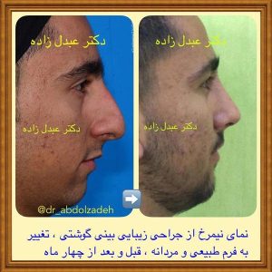 جراحی-بینی-50