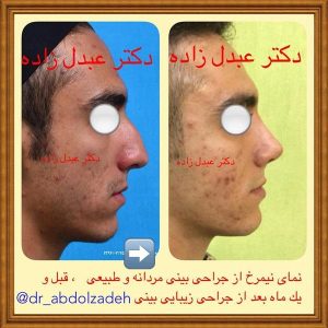 جراحی بینی طبیعی در تهران - دکتر عبدل زاده