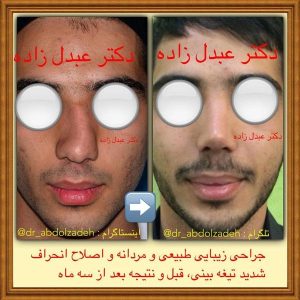 جراحی بینی طبیعی در تهران - دکتر عبدل زاده
