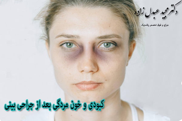 کبودی بعد از جراحی بینی - دکتر عبدل زاده