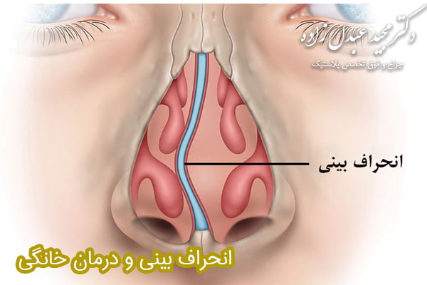 درمان انحراف بینی با دکتر عبدل زاده 
