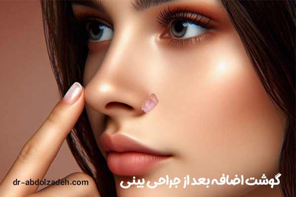 گوشت اضافه بعد از جراحی بینی - دکتر مجید عبدل زاده