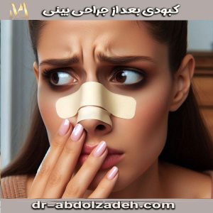 کبودی بعد از جراحی بینی از دکتر مجید عبدل زاده ، بهترین جراح بینی تهران