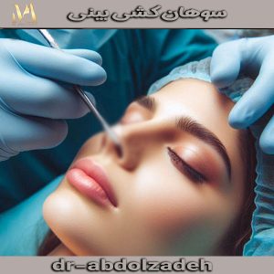 سوهان کشی بینی از دکتر مجید عبدل زاده ، جراح بینی متبحر در کرج